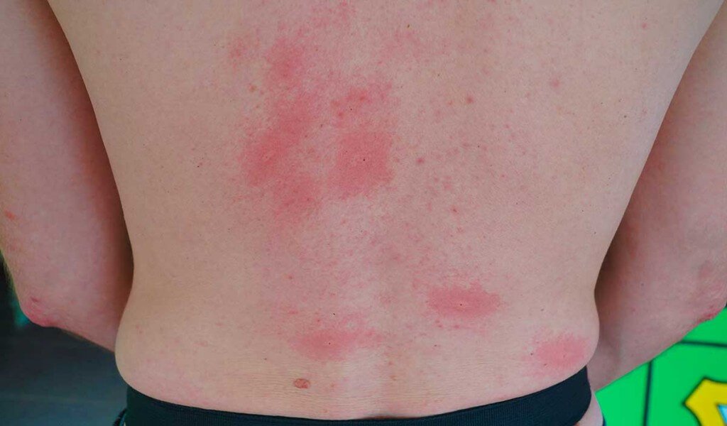 And this is the back of a group member that insisted on hiking uphill with his shirt off.